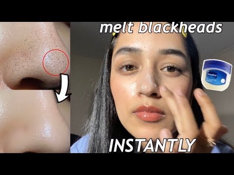 I removed my blackheads INSTANTLY w/ VASELINE + OIL! | How to get rid of blackheads