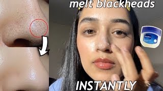 I removed my blackheads INSTANTLY w/ VASELINE + OIL! | How to get rid of blackheads screenshot 3