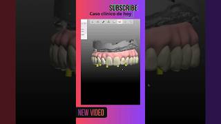 Encía #3shape #dentist #dental #odontologiadigital #odontologia #dentista #dentistry