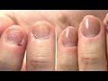 Short Bitten Nails & Skin Transformation