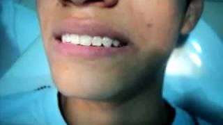 Video thumbnail of "como te quitan los brackets (ortodoncia )"