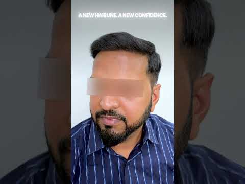 Hair transplant transformation video 3