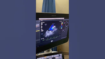 Patent Foramen Ovale Transesophageal Echocardiography 