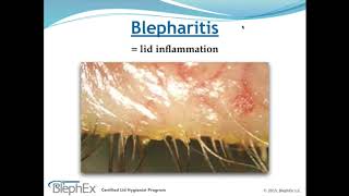 Dry Eye Decoded Webinar