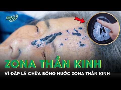 Đắp lá chữa bóng nước, người phụ nữ 72 tuổi suýt mù mắt vì biến chứng zona thần kinh | SKĐS