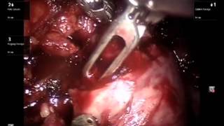 Thrombosis 10 ivc icd