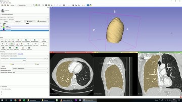 Organ segmentation 3.1 : Lungs, lobes, volumetry