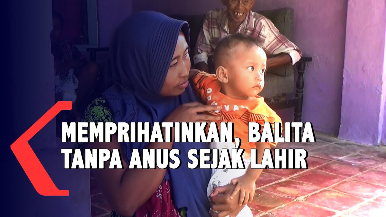 Memprihatinkan Balita Tanpa Anus Sejak Lahir