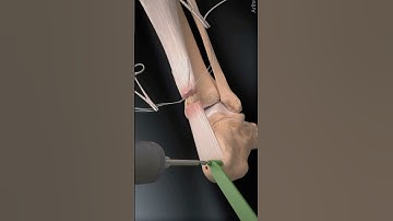 A step-by-step visualization of Achilles tendon reconstruction…💫Credit: @arthrexmeded (IG)