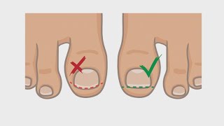 How to Best Handle and Treat an Ingrown Toenail