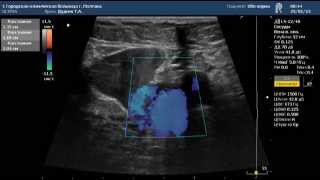 Ультразвуковое исследование вен нижних конечностей(, 2014-11-03T12:53:27.000Z)