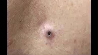 Video thumbnail of "Blackheads"