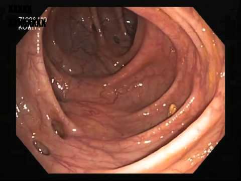 Diverticulosis lesion from Colonoscopy - YouTube