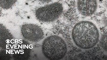 U.S. investigates more cases of suspected monkeypox