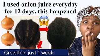ONION JUICE! THE WORLDS most POWERFUL SERUM for HAIR REGROWTH! Onion juice before & after results