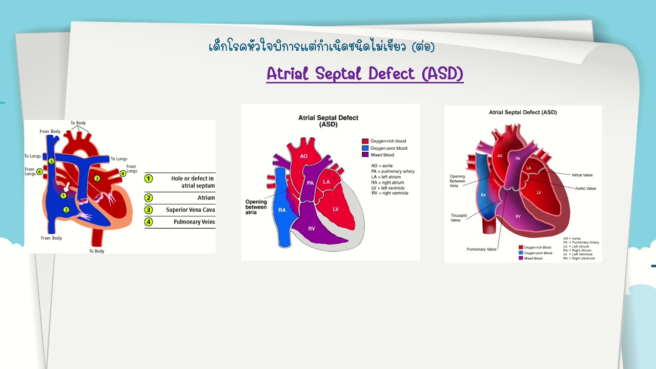 .vsd คือ  Update New  การพยาบาลเด็กโรคหัวใจ PDA