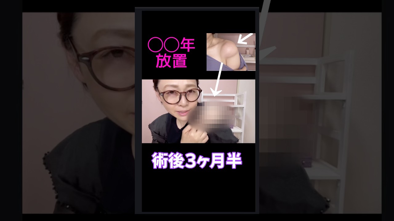 術後、3ヶ月半後の傷あと 質問にお答え致します。 #脂肪腫 #脂肪腫摘出手術