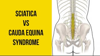 Sciatica vs Cauda Equina Syndrome (MEDICAL EMERGENCY!)