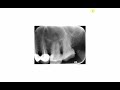 Is the root inside the maxillary sinus or not? A method to follow in periapical radiographs.