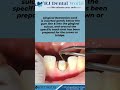 Gingival Retraction Cord Placement Of Gingival Retraction Cord Rj Dental World 