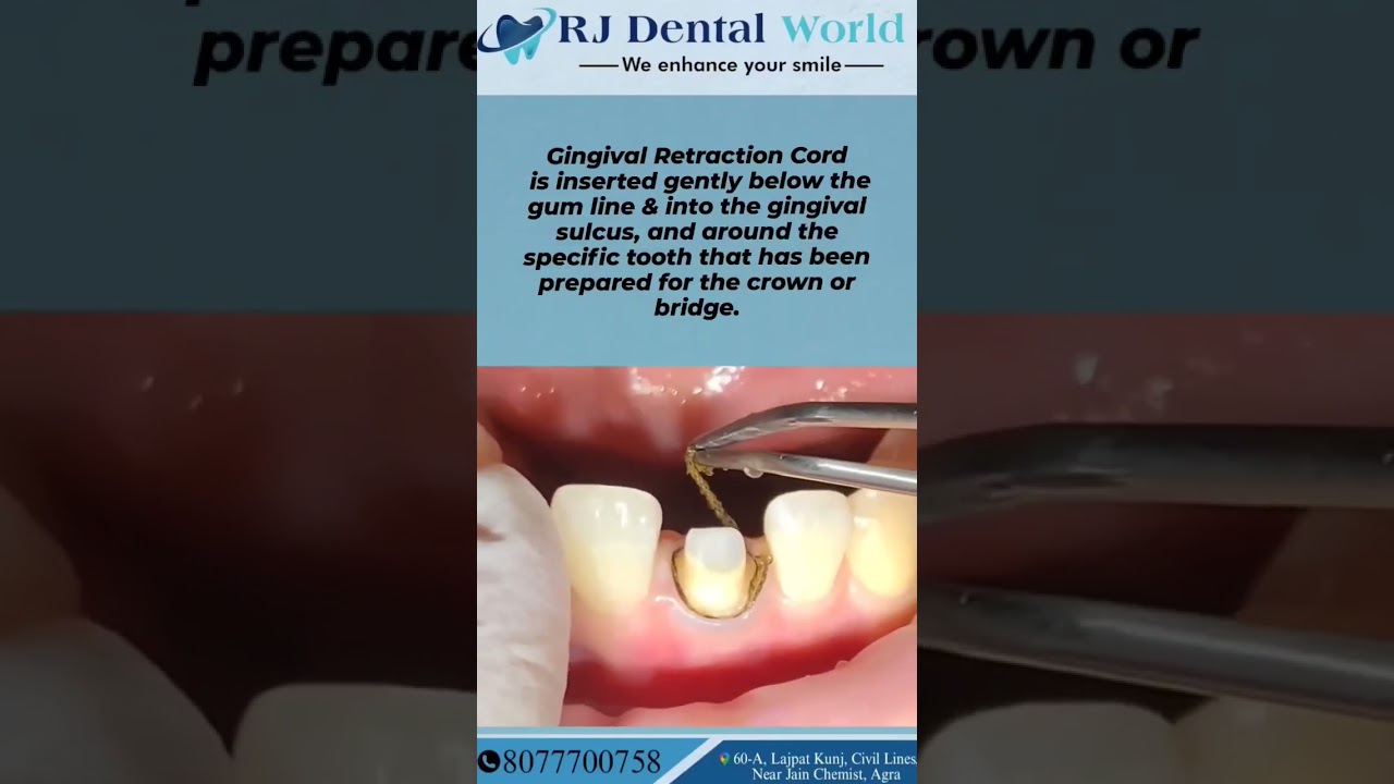 Gingival Retraction Cord | placement of gingival Retraction Cord | Rj Dental World
