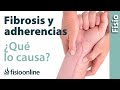 Fibrosis y adherencias - ¿Qué es y cuáles son sus causas?