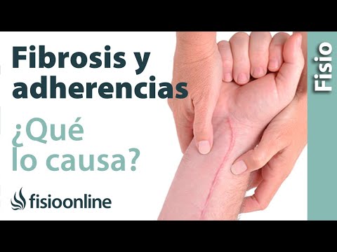 Fibrosis y adherencias - ¿Qué es y cuáles son sus causas?