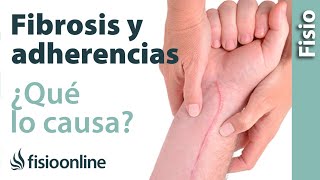 Fibrosis y adherencias  ¿Qué es y cuáles son sus causas?