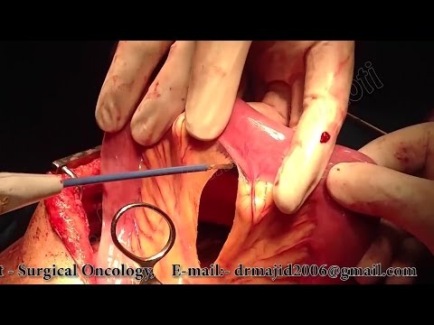 Video: Gastrectomie: Doel, Procedure En Typen