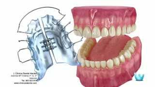 Orthodontics: Aesthetics or Oral Health Prevention?