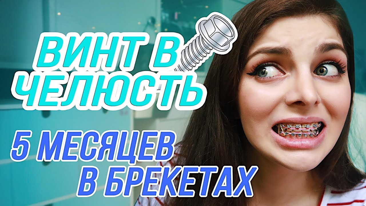 ПОЛГОДА В БРЕКЕТАХ / Винт в челюсть!