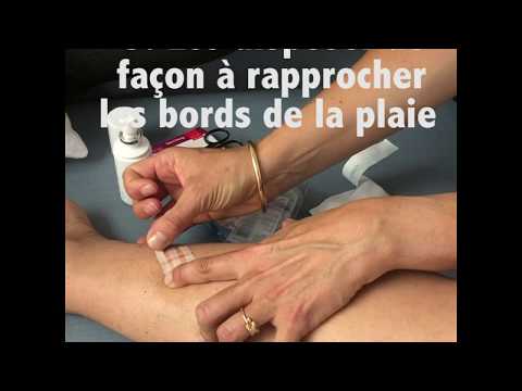 Vidéo: Comment suturer les plaies (avec photos)