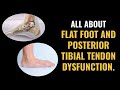 Flat Foot and Posterior Tibial Tendon Dysfunction - What you need to know!