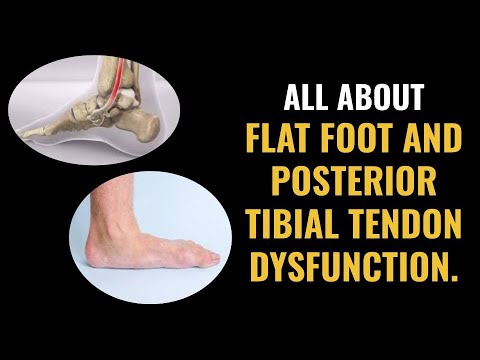 Flat Foot and Posterior Tibial Tendon Dysfunction - What you need to ...