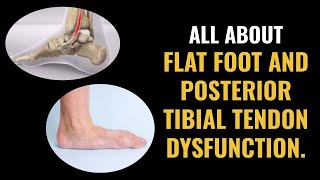 Flat Foot and Posterior Tibial Tendon Dysfunction - What you need to know!