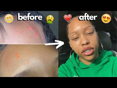 how-i-got-rid-of-my-acne-+-got-clear-skin-within-a-month-(photo-proof)-|-skincare-routine-2020