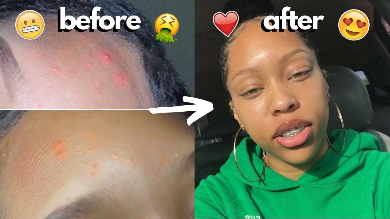 HOW I GOT RID OF MY ACNE + GOT CLEAR SKIN WITHIN A MONTH (PHOTO PROOF ...