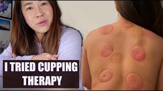 I Tried Cupping Therapy