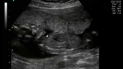 Gina LaBarbera's 17 week ultrasound Part 2 - 3D Co...