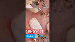 pimple popping 2022 new, blackheads on nose, pimple popping tiktok 553335