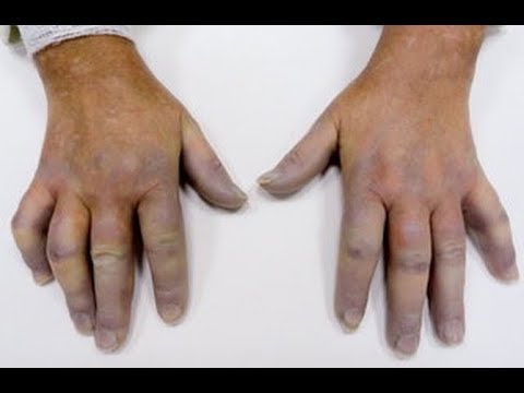 Wideo: Cellulitis: Przyczyny, Objawy, Leczenie I Obrazy