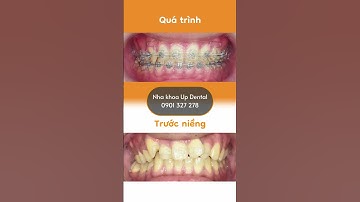 Hành trình LỘT XÁC nhờ niềng răng của Hoàng Nam