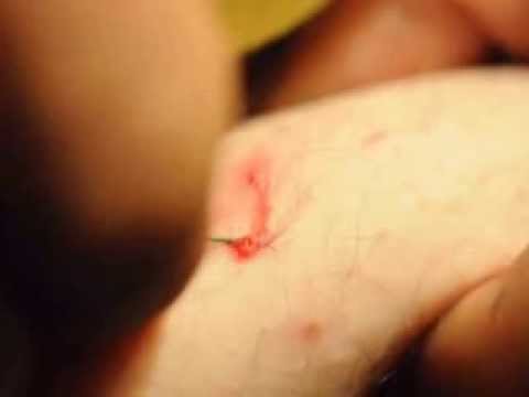 Como quitar un pelo enquistado ingle