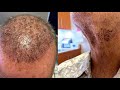 Dallas Corrective Hair Transplant Testimonial