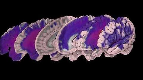 ATLAS Stroke Project