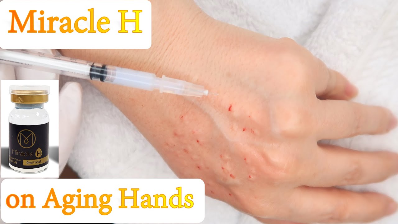 Miracle H skin booster on Aging Hands Hand Rejuvenation Crepey Skin