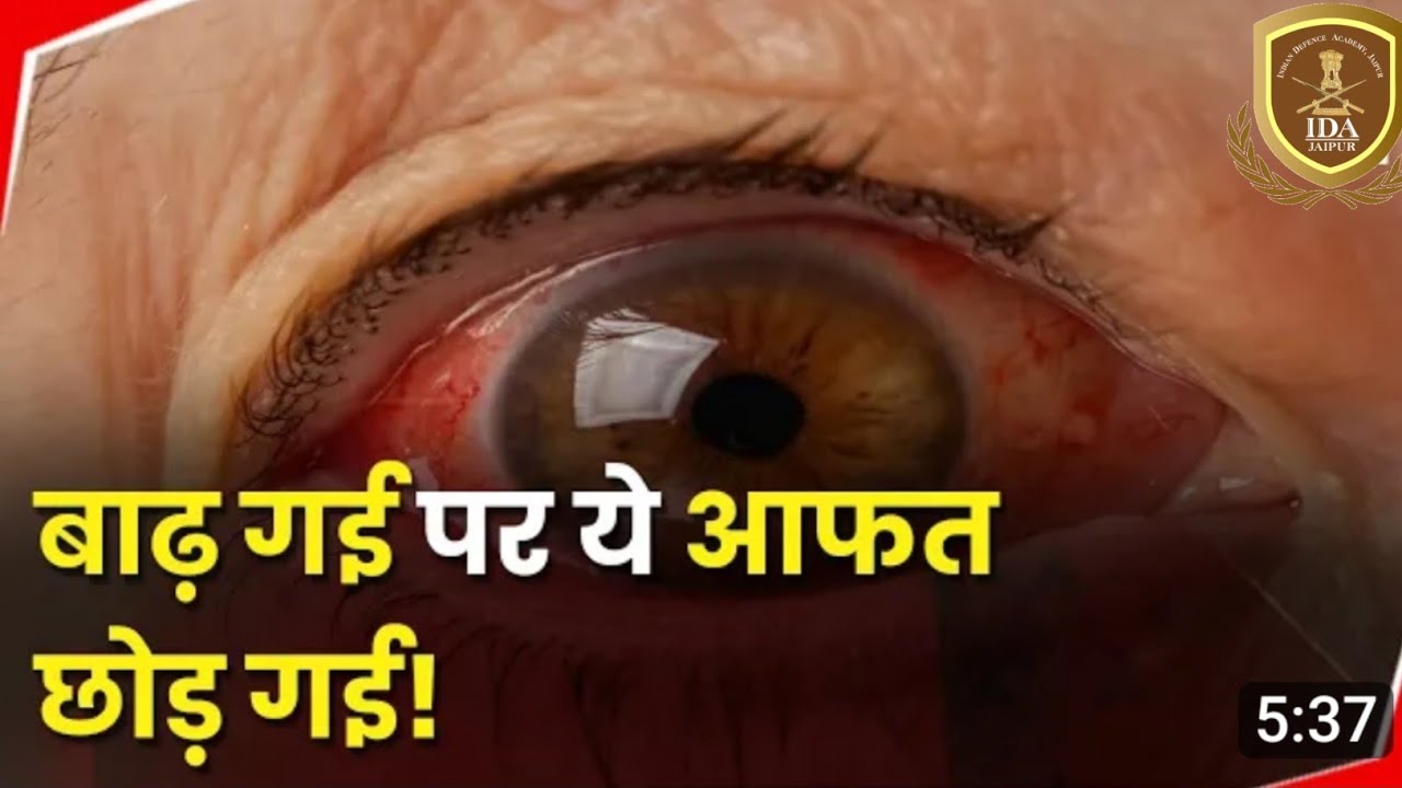 Eye Flu Conjunctivitis yani Eye Flu kya hota hai, Eye flue के बारे