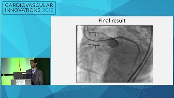 CVI2018 Session: The dreaded old vein graft - Arslan Shaukat