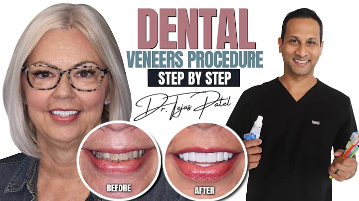 Dental Veneers Procedure Step by Step with Dr. Tejas Patel!