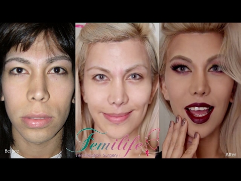 facial-feminization-surgery-before-and-after-procedures